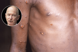 La variole du singe «ne peut pas passer inaperçue à l’inverse du Covid-19»